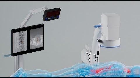 Navient 2D C-arm navigation for Spine surgery