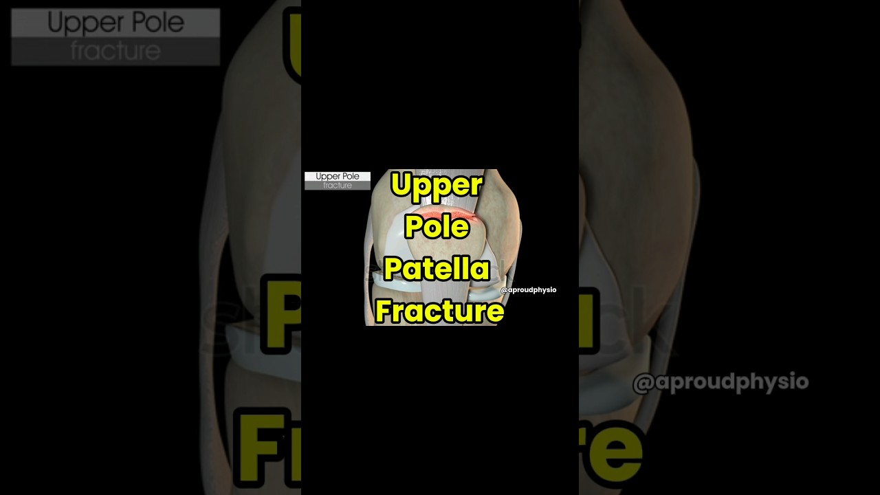 Patella Fracture | Upper pole fracture | Anatomy Video