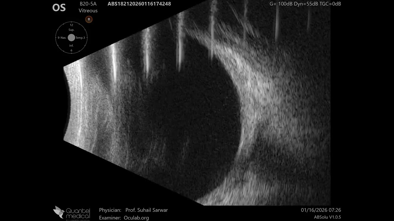 20 MHz Annular Ophthalmic Ultrasound ABSolu, Fungal orbital cellulitis , 36925