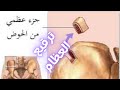 ترقيع العظام ما هو الترقيع العظمي ترقيع العظام ترقيع العظام من الحوض النخاع العظمي ترقيع العظام ما هو الترقيع العظمي ترقيع العظام ترقيع العظام من الحوض النخاع العظمي