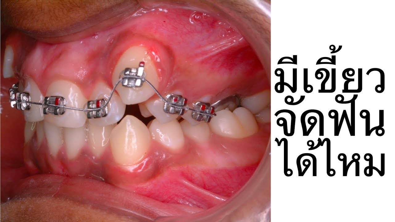 จัดฟันต้องถอนเขี้ยวไหม (High Canine Teeth! Braces) YouTube