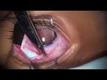Surgery: Enucleation by the Myoconjunctival Technique: Dr. Santosh G. Honavar