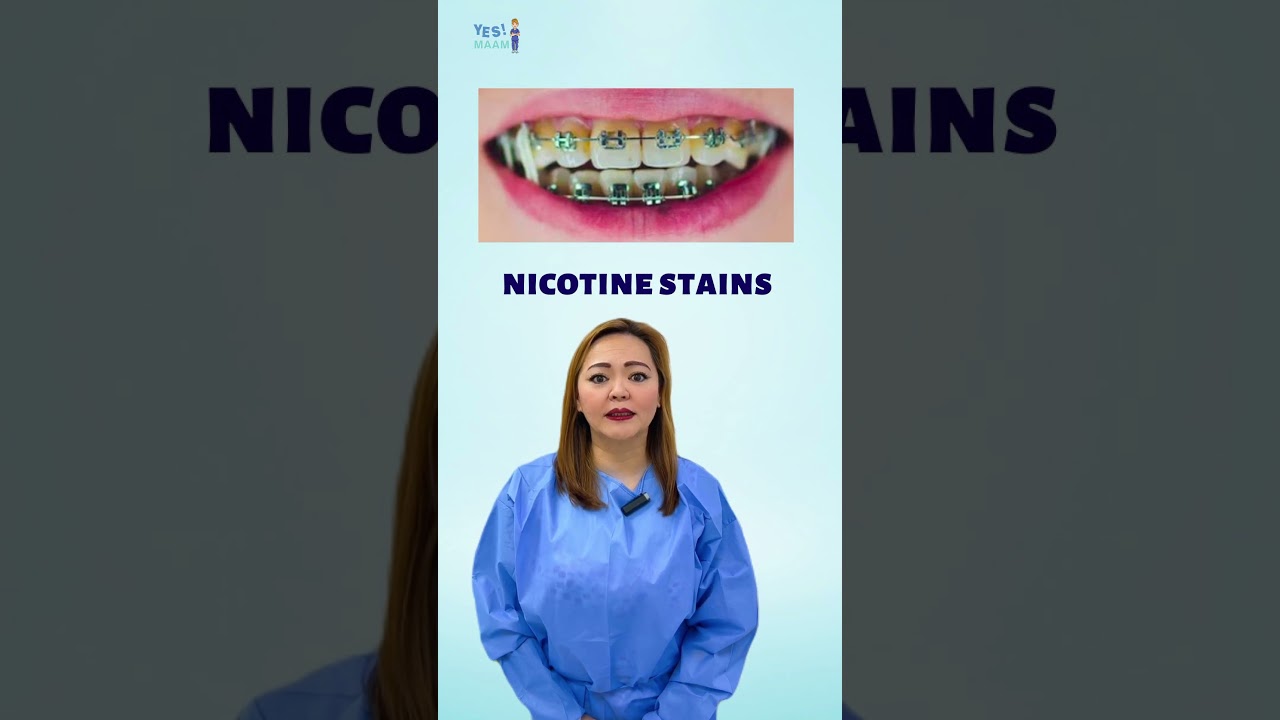 can you vape with braces Is Vaping With Braces Safe? Stop Now to Save Your Smile main image 1
