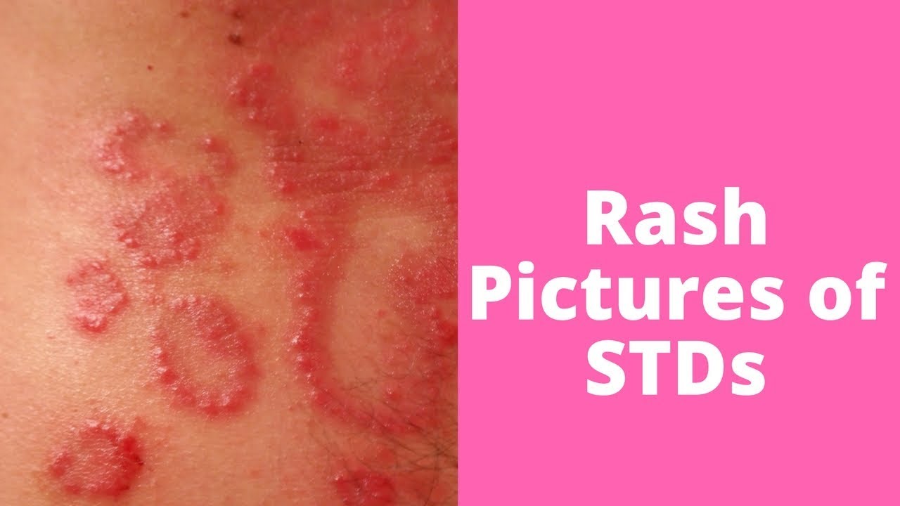 Is your skin rash an STD rash?. Any change in the genital area invites…, by CupidCare
