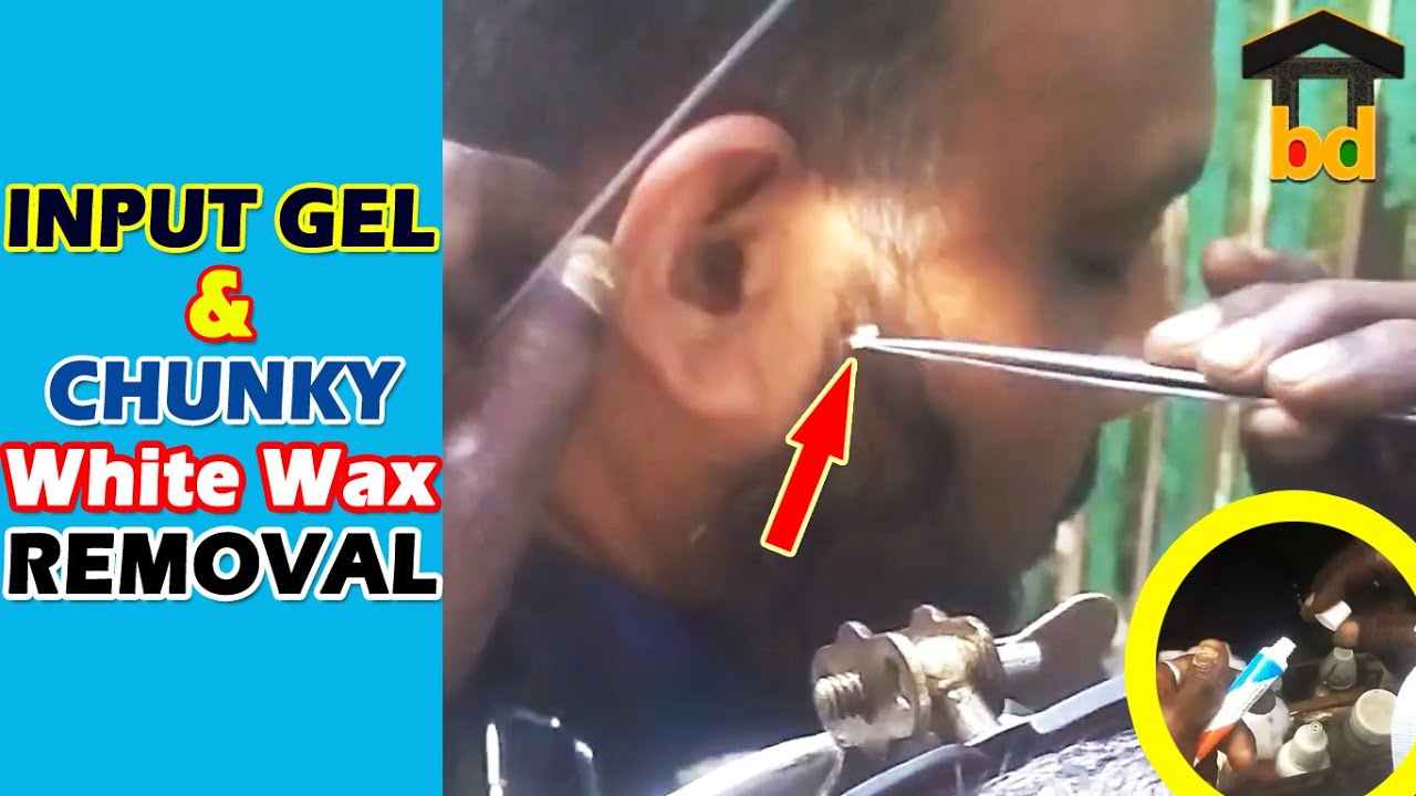 ASMRChunky White Earwax Removal from Ear Canal and Eardrum at Busy