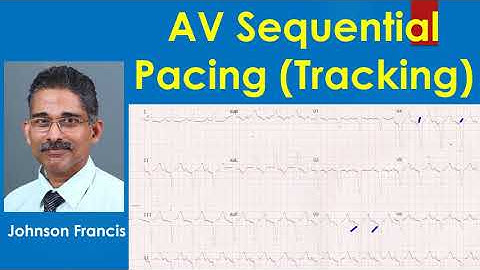 AV Sequential Pacing (Tracking)