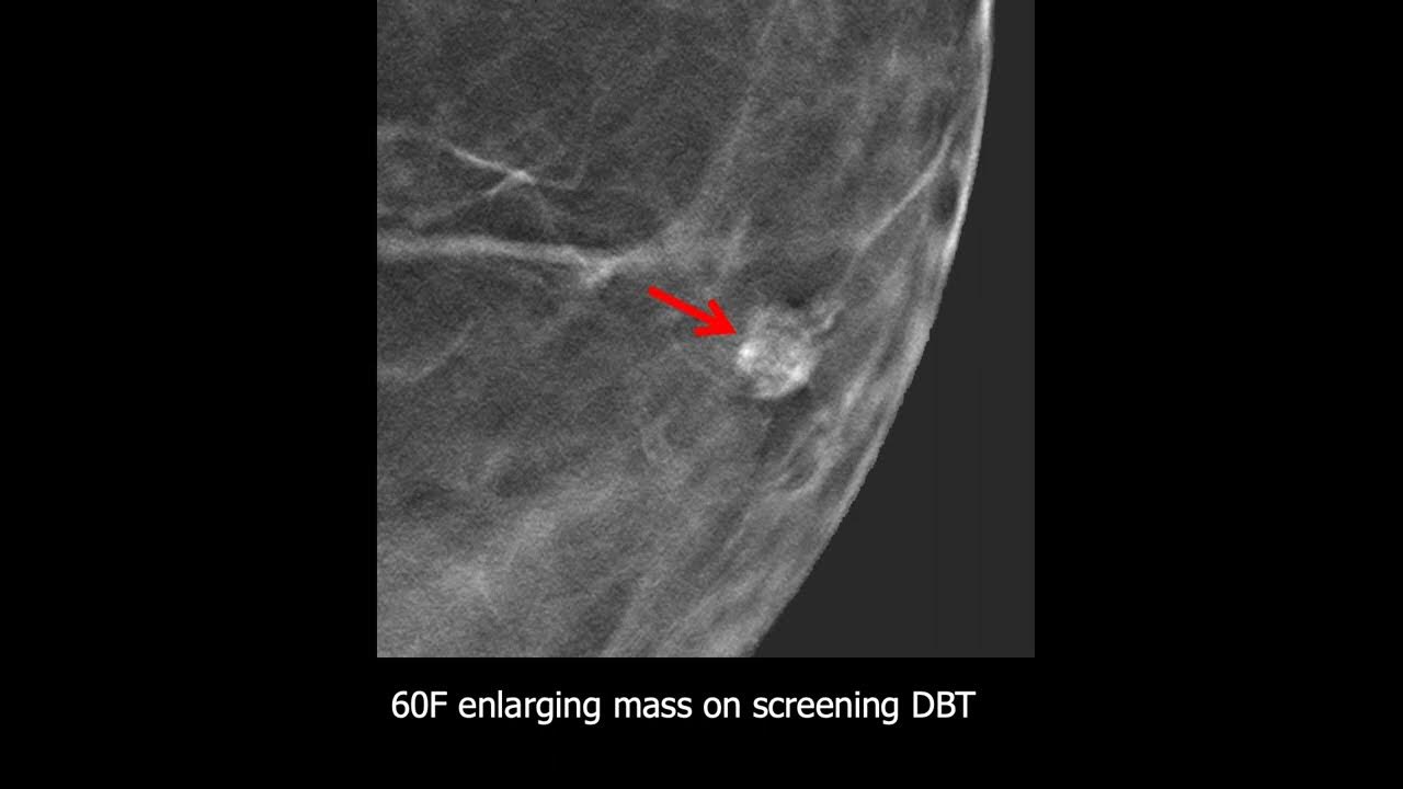 Improving Specificity of Breast Ultrasound BIRADS 3 and 4A YouTube