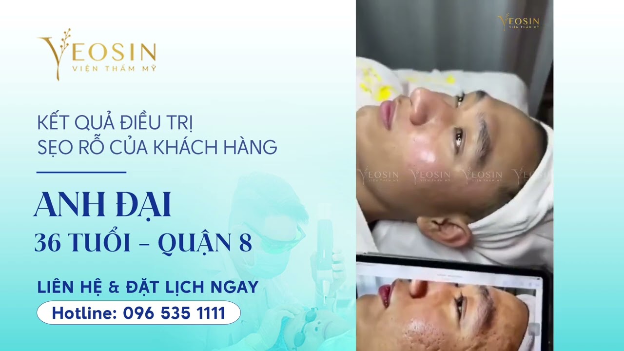 Điều trị sẹo rỗ hiệu quả bằng công nghệ Filling Scars 17 YouTube video