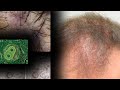 Autoimmune Hair Loss Diseases Cause other Disorders