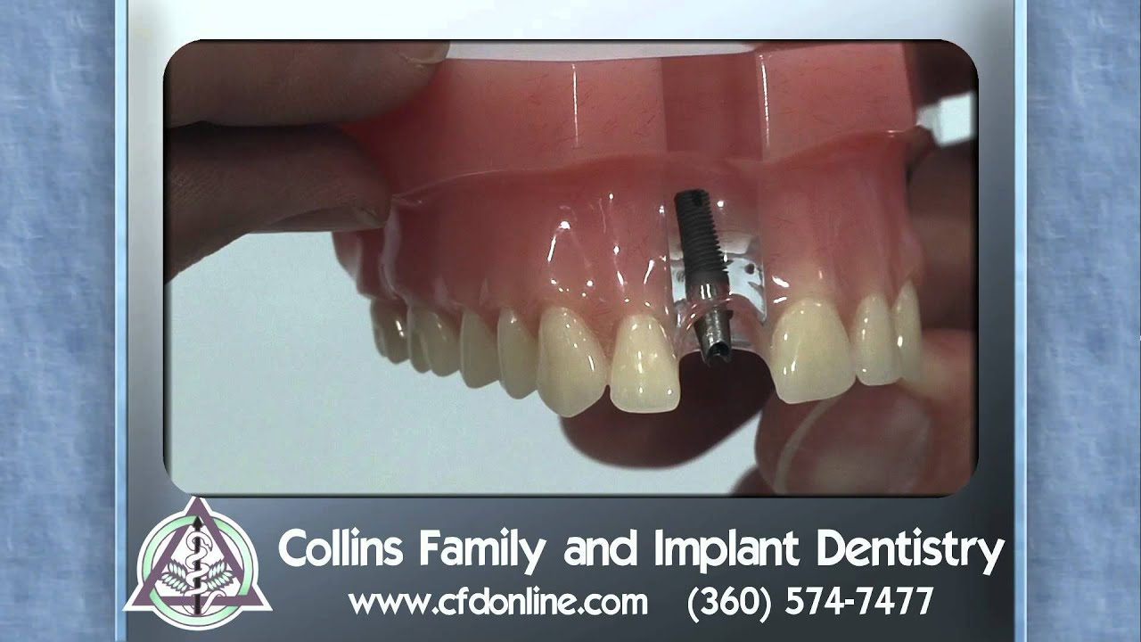 What is a dental implant? Single tooth implants in Vancouver, WA YouTube