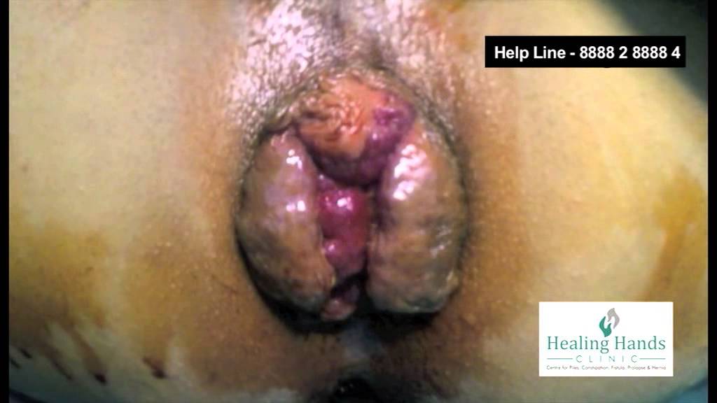 down-causes-of-irritated-anus-mot-hemorrhoids-teens-taking-teen