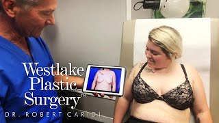 Breast Lift With Implants Surgery Before And After Mastopexy And Augmentation