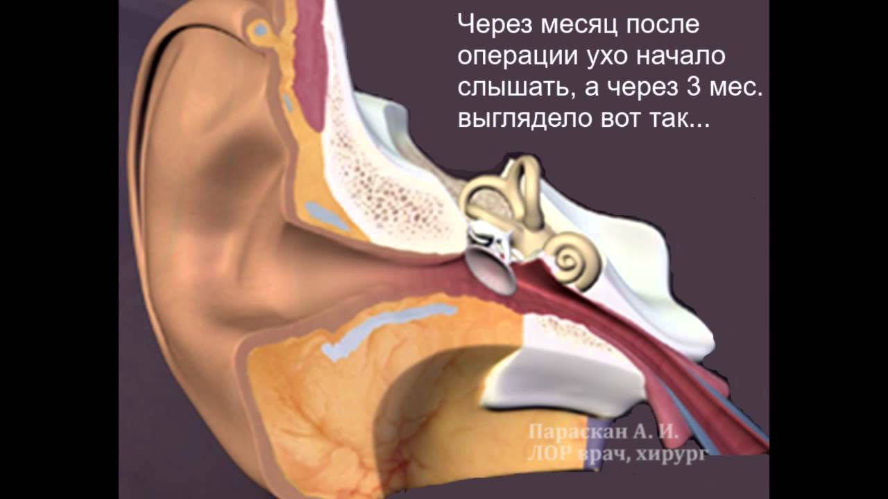 Шунты в уши ребенку. Тимпанопластика барабанной перепонки уха. Тимпанопластика холестеатома. Тимпанопластика уха холестеатома. Хронический отит операция тимпанопластика.