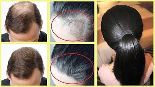 علاج تساقط الشعر الشديد نهائيا وفي وقت قصير جدا أسرع طريقة من أجل تكثيف الشعر و تطويل الشعر