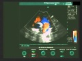 V. Pavliuk MD, PhD. Echocardiographic Examin-n: Adjusting the Basic Settings for an Opt-l Visual-n