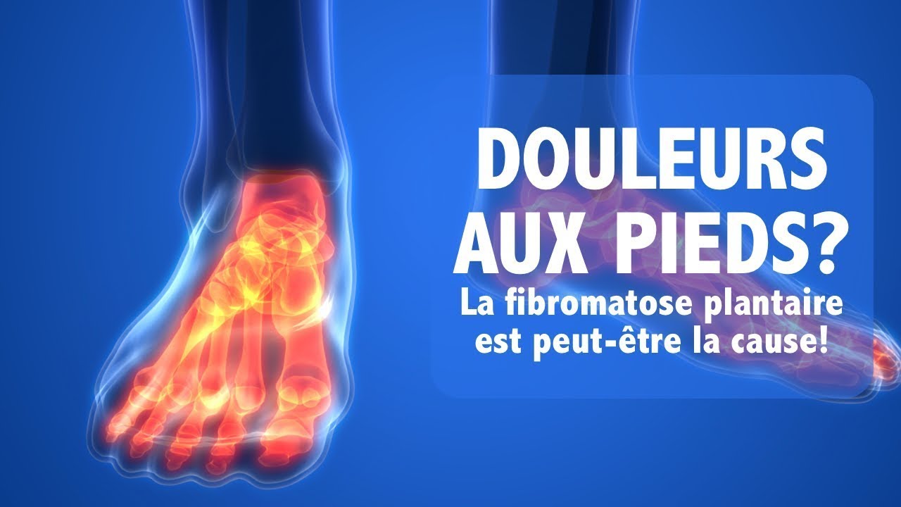 DOULEURS AUX PIEDS La fibromatose plantaire est peut tre la cause maladie de Ledderhose