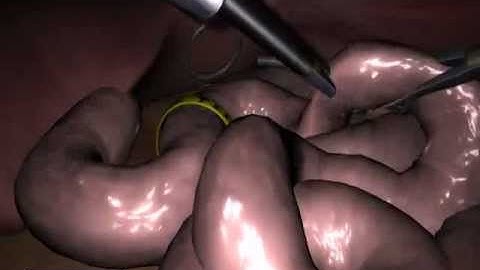 LapSim Basic Skills: Running through Bowel