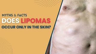 Does Lipoma only occur in the skin? | Best Lipoma Treatment | Lipoma surgery in Delhi | @SkinQure