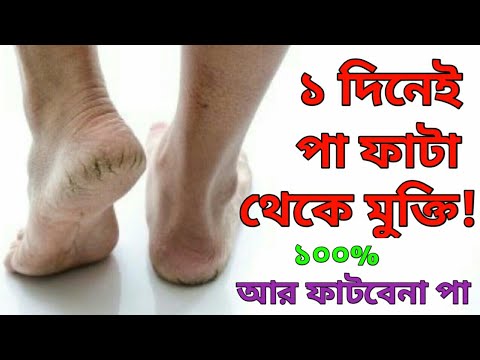 ভিডিও: পা ফাটা রোধ করার টি উপায়