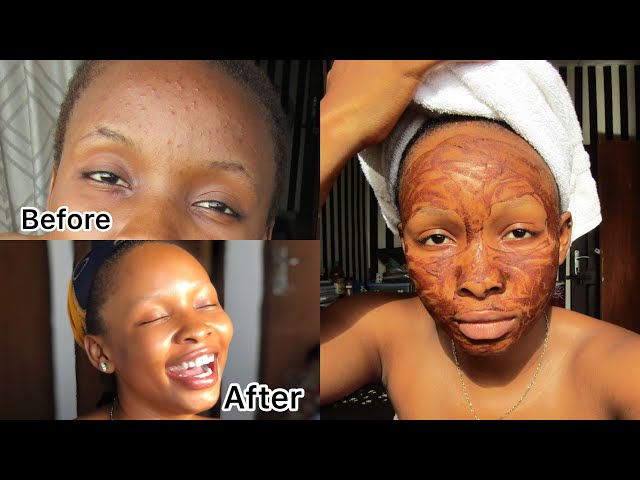 How To Get Rid Of Acne/Pimples In One Week Using CINNAMON Mask class=