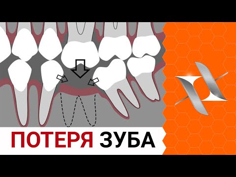 Что делать если удалили зуб? | Нужен ли имплантат?