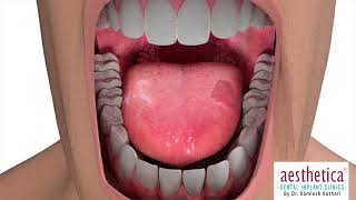 Treatment of Oral Cancer | Aesthetica Dental Implant Clinic | Dr. Kamlesh Kothari screenshot 4