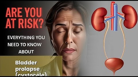 Bladder prolapse (cystocele) Explained Causes, Symptoms and Treatment, All Insights