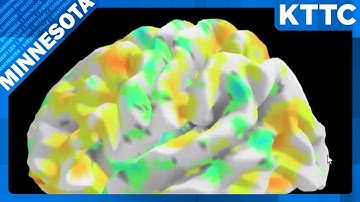 Mayo Clinic researchers define a new memory loss syndrome often mistaken for Alzheimer’s