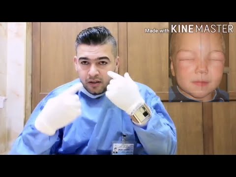 متلازمة التناذر الكلوي للاطفال