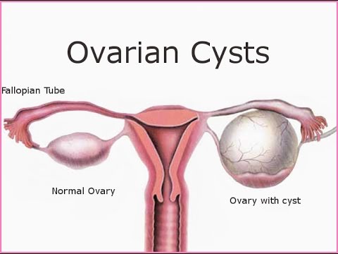 How to treat ovarian cysts without birth control