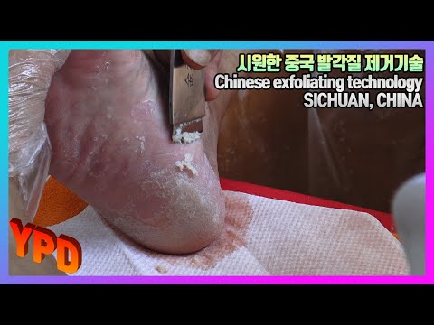 A121 Amazing Chinese exfoliating technology 아기발로 만들어 주는 놀라운 중국 사천 각질제거 기술2, sichuan, CHINA