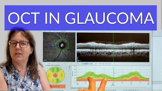 Using OCT in Glaucoma - Tutorial for Beginners