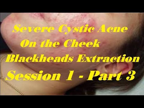 Severe Cystic Acne Treatment On the Face Easy Blackheads Extraction l Session  Part  HD