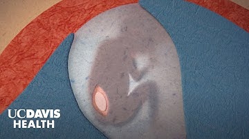 Fetal Surgery for Spina Bifida (Myelomeningocele) - UC Davis Children