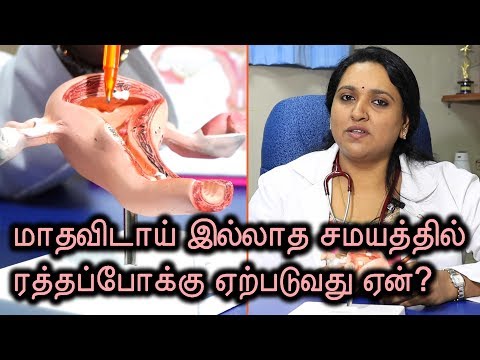 Abnormal Uterine Bleeding Causes & Treatment | Dr. Deepa Vinay Nambiar | Samayam Tamil