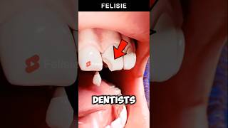 Do This If Your Tooth Is Chipped