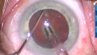 TBWTDCS #152: 3-4  Dense Lens, Terminal & Cross Chop. Avoid the Posterior Plate. Reduced CDE.