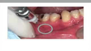 Predictable Local Anesthesia proof 2 screenshot 4