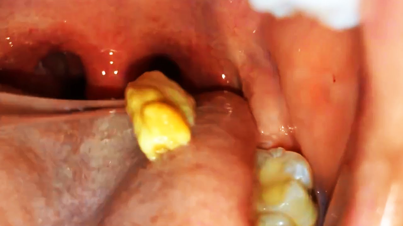 Biggest Tonsil Stone Popping Yet Removed Youtube