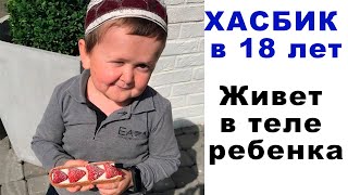 Как такое возможно? Парень 18-ти лет живет в теле 5 летнего малыша. История ХАСБИКА