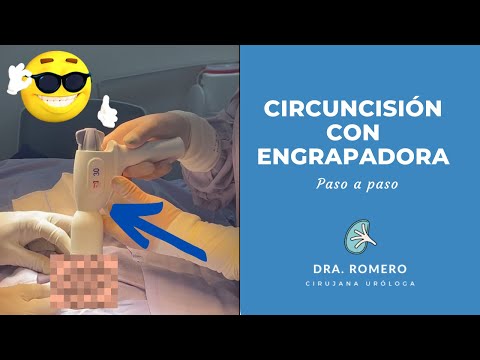 Circuncision con engrapadora Circcurer