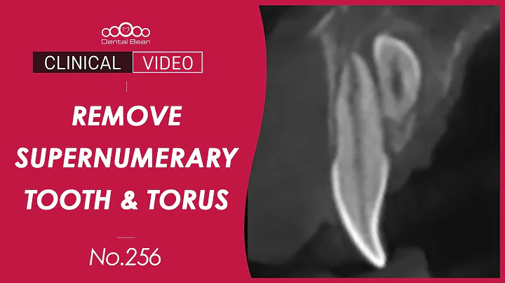 Extraction of supernumerary tooth / Lingual torus removal - [Dr. Cho Yongseok] - DayDayNews