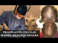 Trasplante de células madre mesenquimales para tratar la alopecia.