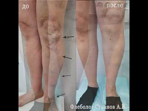 Операция по удалению варикоза на ногах. Варикоз фото до и после операции. Операция без разрезов.