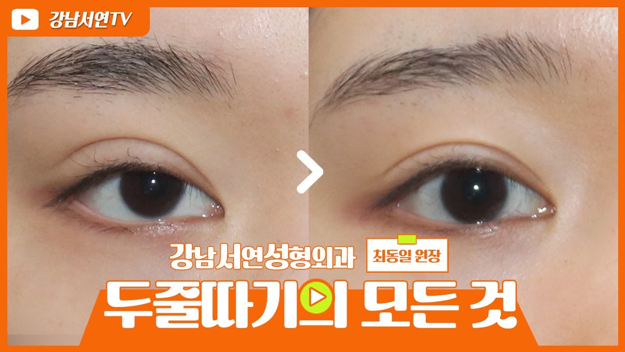 [Ганнам Соён гоо сайхны мэс заслын эмнэлэг] Гоо сайхны мэс заслын судалгаа I Давхар зовхины илүү шугамыг засах нь: Бүх зүйл | Шугам намсгах, Хиам шиг давхар зовхи, Давхар зовхины дахин