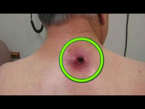 Cease and De-Cyst!  14 Minutes of Cyst Removal with Dr. Gilmore