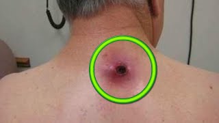 Cease and De-Cyst!  14 Minutes of Cyst Removal with Dr. Gilmore