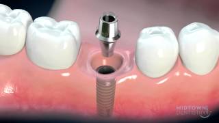 Dental implant consent by Dentalism 124,660 views 9 years ago 8 minutes, 45 seconds