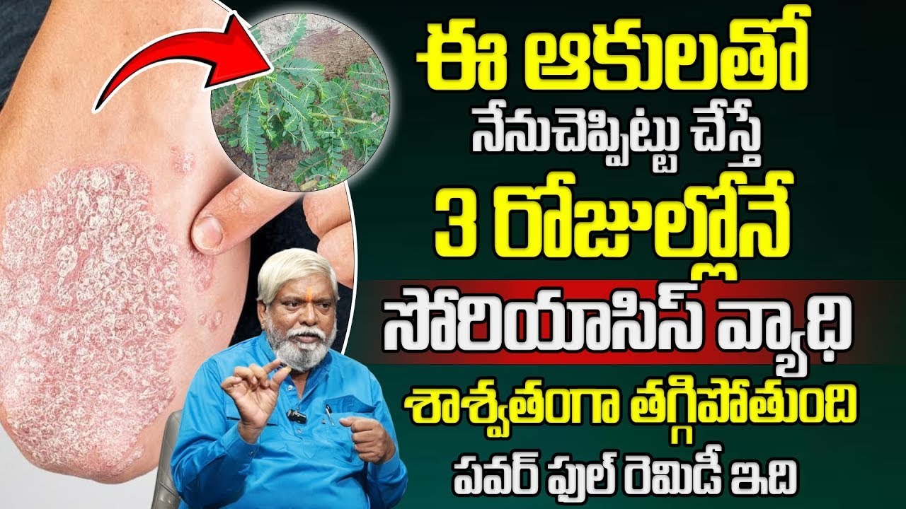 సోరియాసిస్ ఉన్న చోట ఇది రాస్తే శాశ్వతంగా తగ్గిపోతుంది | Psoriasis Remedies | Dr Pandit Srinivas