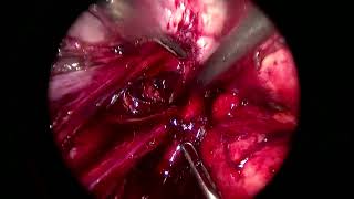 Deep pelvic endometriosis, laparoscopic excision of rectovaginal nodule